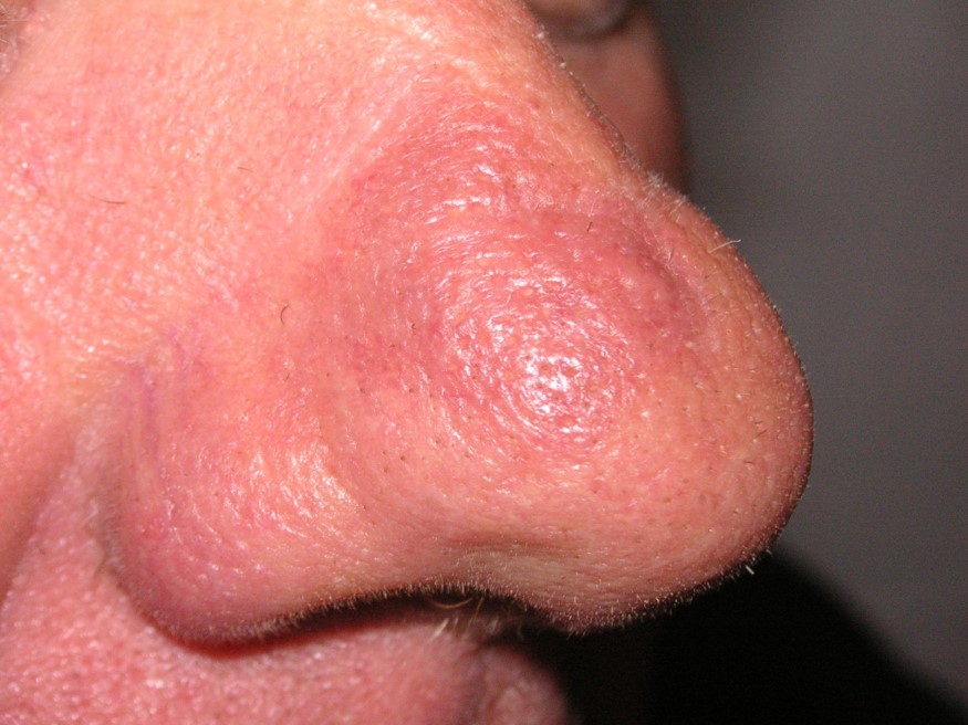 Granuloma faciale.jpg