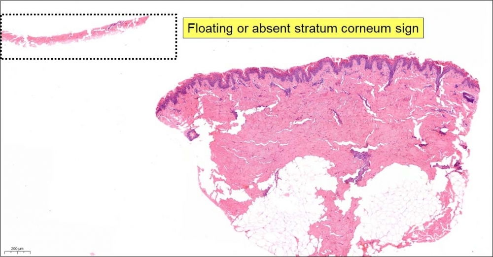 floating stratum corneum sign.jpg